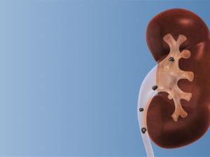 A New Peril of Modern Life for Kids: Kidney Stones