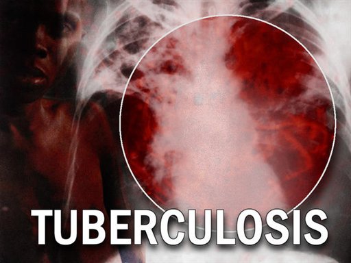 Not Scared of TB? You Should Be