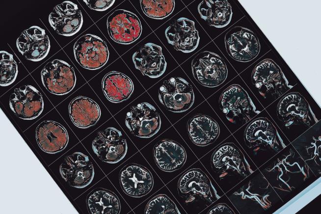 There Is No Mysterious Brain Disease in Canada