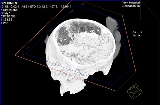 Scientists Find 2,000-Year-Old Brain in Britain