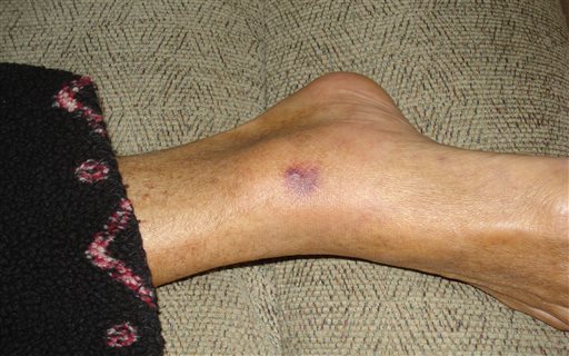 Flesh-Eating Bacteria Deaths Surge on Southeast US Coasts