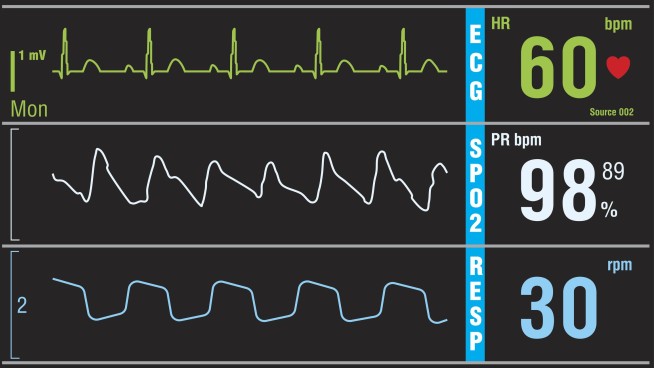 Warning Signs Are Clear for Future Heart Trouble: Research