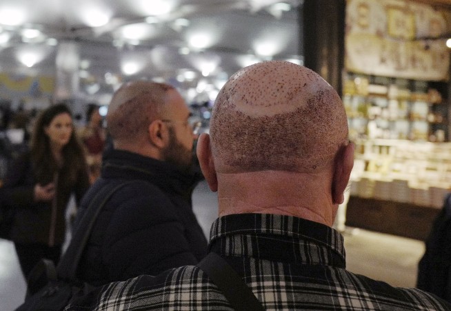 Why Balding People Are Vacationing in the Middle East