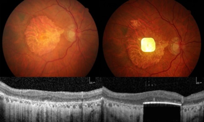 Bionic Retina Lets Blind Patients Read Again