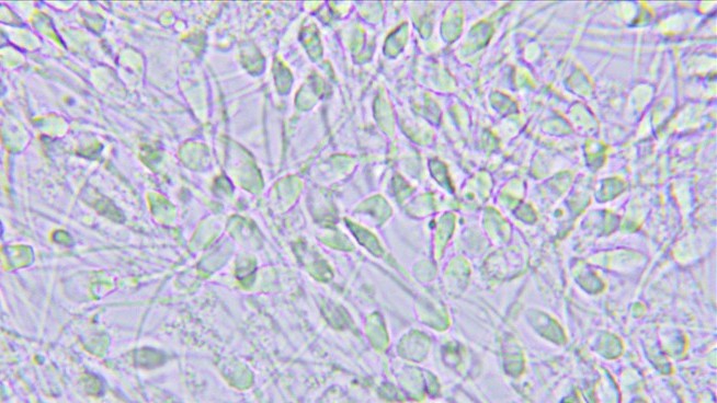 197 Kids Born From Sperm Donor With a Dangerous Gene