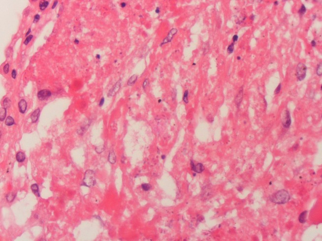 Soil Fungus Sickens Dozens in Tennessee