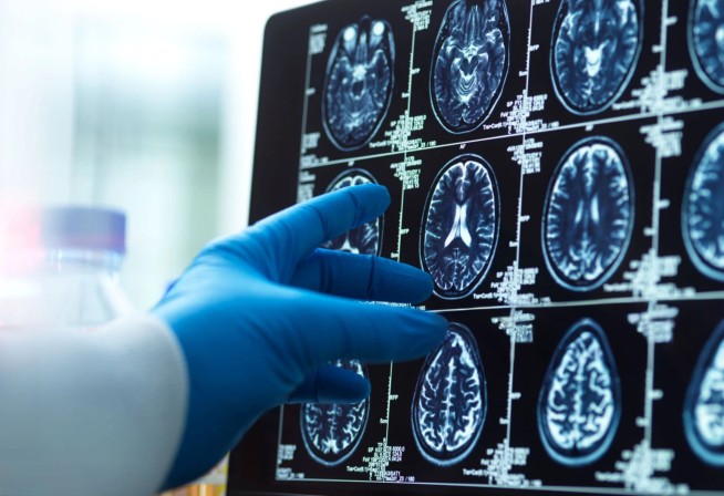 Alzheimer's Diagnosis at 57 Shows Power of Intervention