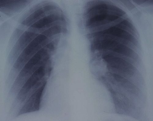 Hormone Therapy Nearly Doubles Lung Cancer Risks