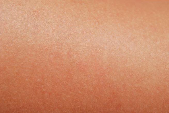 New Vaccine May Cure Skin Cancer