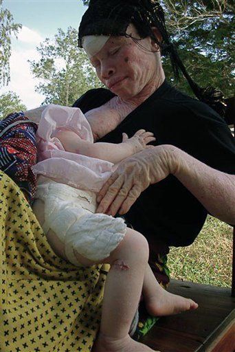 Albino Girl Beheaded in Witchcraft Murder