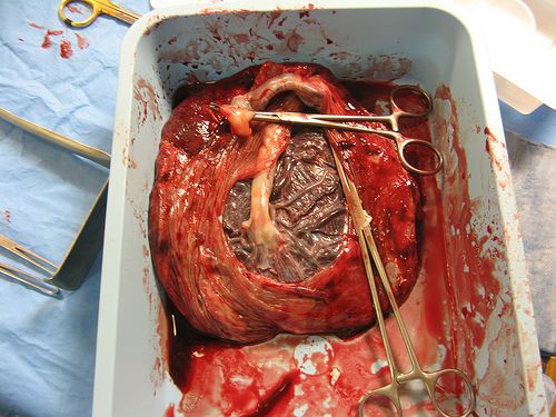 Nursing Student Takes Photo With Placenta, Gets Expelled