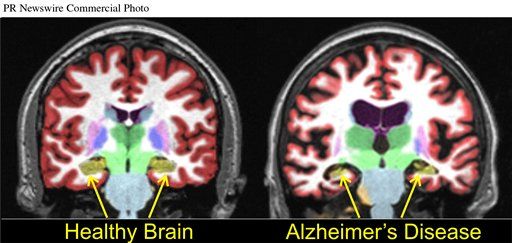 Simple Blood Test May Detect Alzheimer's