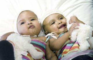 Conjoined Twins Rital and Ritag Gaboura, Joined at Head, Successfully Separated
