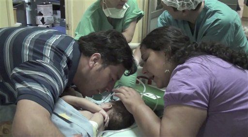 Chilean Doctors Separate Conjoined Twins in 18-Hour Operation