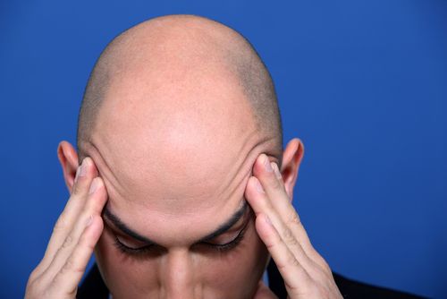 Researchers Find a Clue to Baldness