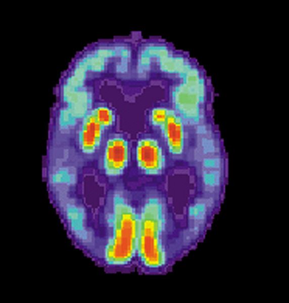 Test Spots Alzheimer's Decades Before Symptoms Appear