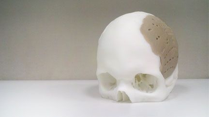 Surgeons Replace 75% of Guy's Skull —Using 3D Printer
