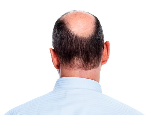 Bald Men Have Higher Heart Risks