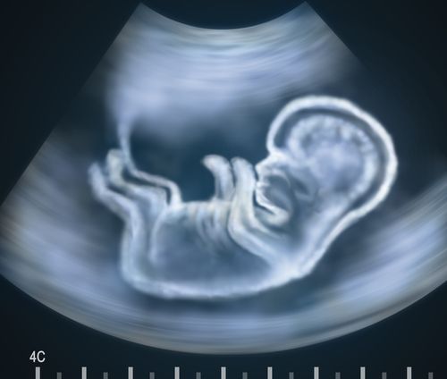 Why I Had My Abortion at 23 Weeks