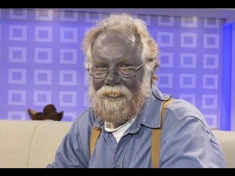 Man Whose Skin Was Blue Dead at 62