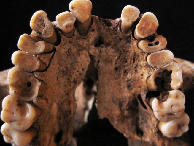 Stealth Carbs in Paleo Diet Rotted Ancients' Mouths
