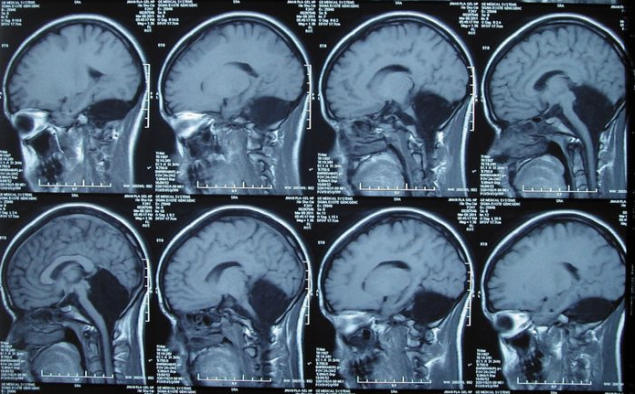24-Year-Old Discovers She's Missing Key Part of Brain