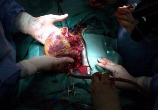 World's First 'Dead Heart' Transplants Successful
