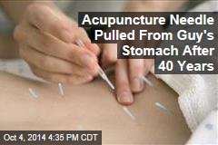 Acupuncture Needle Pulled from Guy&#39;s Stomach After 40 Years