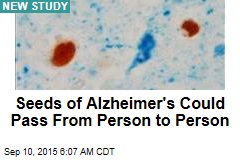 Seeds of Alzheimer&#39;s Could Pass From Person to Person