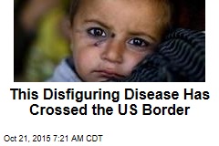 This Disfiguring Disease Has Crossed the US Border