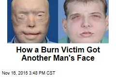 How a Burn Victim Got Another Man&#39;s Face