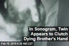 In Sonogram, Twin Appears to Clutch Dying Brother&#39;s Hand