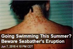 Going Swimming This Summer? Beware Seabather&#39;s Eruption