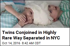 Twins Conjoined in Highly Rare Way Separated in NYC