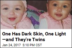 In Rare Case, One Twin Has Light Skin; the Other, Dark