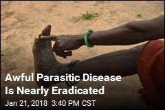 World Is Close to Eradicating Guinea Worm Disease
