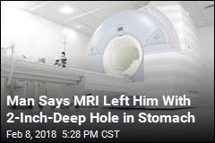 Man Says MRI Left Him With 2-Inch-Deep Hole in Stomach