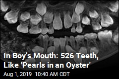 Source of Boy&#39;s Pain Revealed: 526 Extra Teeth