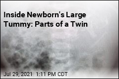 Newborn&#39;s Stomach Mass Had Bones, a Heart