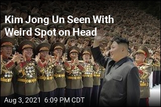 Kim Jong Un Seen With Weird Spot on Head