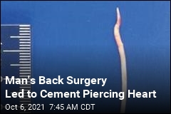 After Surgery, He Was Found With Cement Piercing Heart