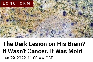 His Brain Ailment Wasn&#39;t Cancer, It Was Mold
