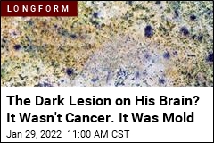 His Brain Ailment Wasn&#39;t Cancer, It Was Mold
