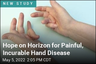 Possible &#39;Game-Changer&#39; for Incurable Hand Disease