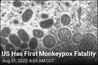 Texas Reports First US Monkeypox Death