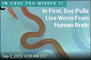 In First, Doc Pulls Live Worm From Human Brain