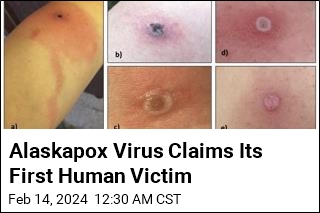 Alaskapox Virus Claims Its First Human Victim