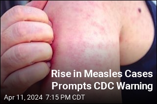 Rise in Measles Cases Prompts CDC Warning