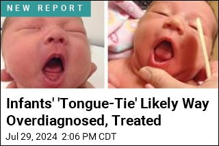 Infants&#39; &#39;Tongue-Tie&#39; Likely Way Overdiagnosed, Treated