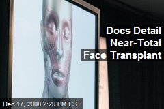 Docs Detail Near-Total Face Transplant